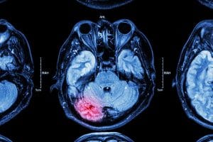 Why You Need an Attorney for Your Brain Injury Case